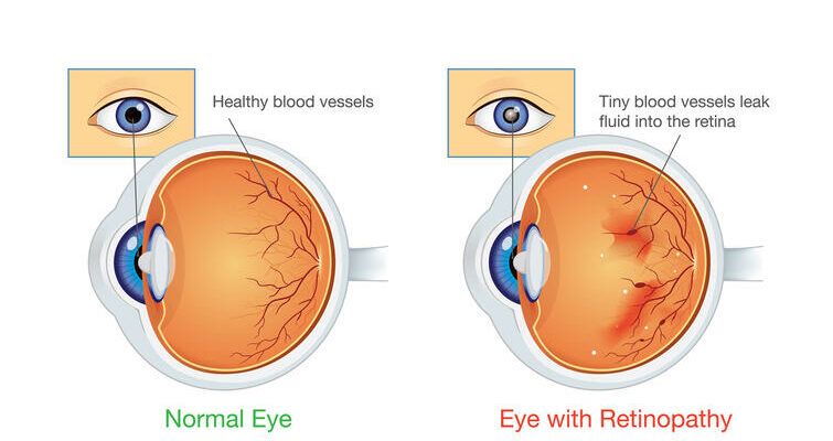 Diabetic Retinopathy Eye Condition
