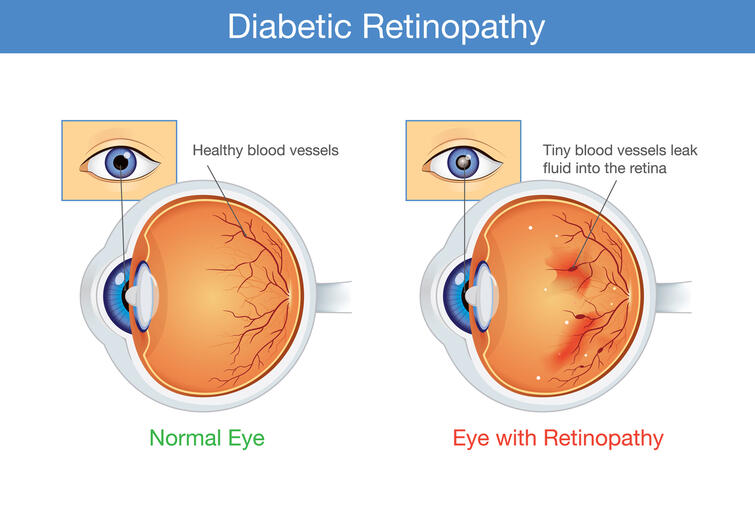 Diabetic Retinopathy Eye Condition